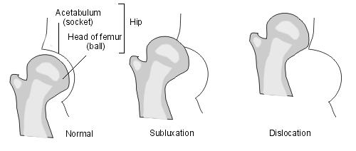 subluxed and dislocated hip