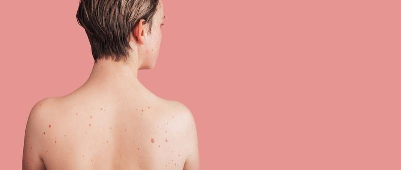 Concerned about a mole? Get peace of mind with online mole checking