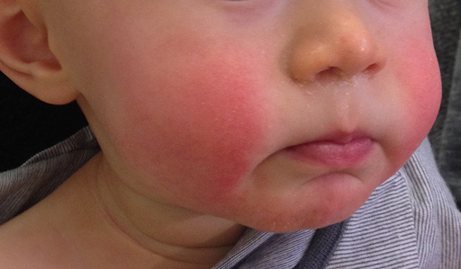 Photo of child with slapped cheek