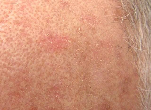 Close view of actinic keratosis