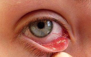 Internal stye