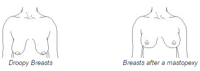 Droopy breasts before and after mastopexy