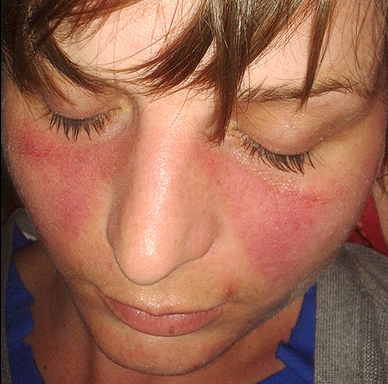The butterfly rash of lupus