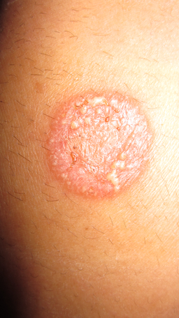 Tinea corporis
