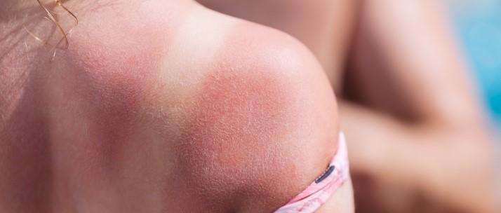 How to treat sunburn blisters