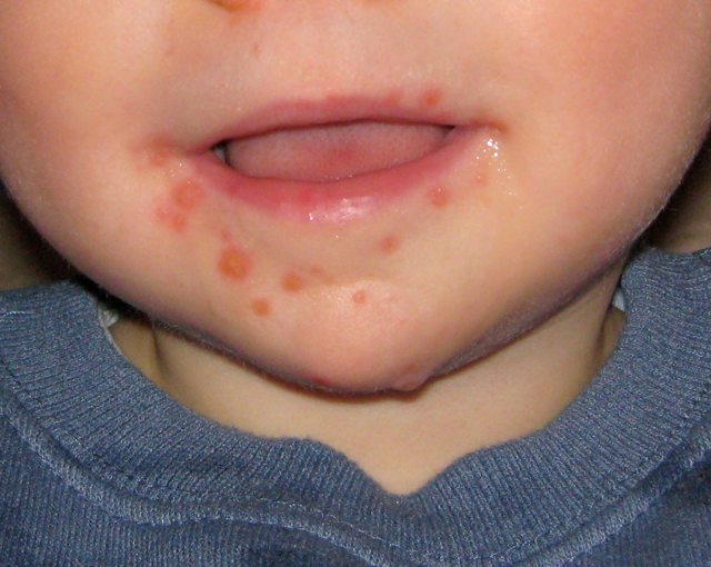 Hand, foot and mouth disease